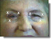 botox for blepharospasm