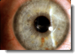 corneal abrasion