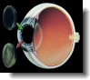 corneal transplant