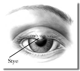 chalazion stye inflammation